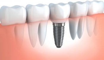 Dental implant Dental implant